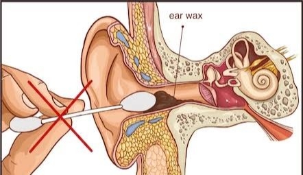 Earwax Blockage: Sign And Symptoms, Causes, Treatment With Home Remedies For Healthy Ear Drum.