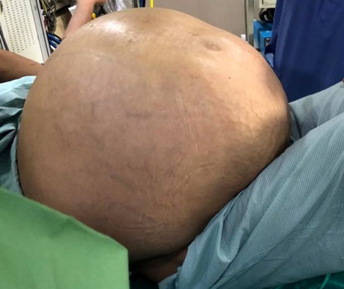 Indian Doctors Remove ‘World’s Largest Ovarian Tumour’ Weighing 50kg From Woman