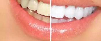 Whiten yiur teeth at home