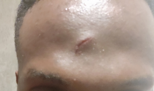 Factors That Affect Wound Healing (Common Question In Surgery Rotations Gambia)