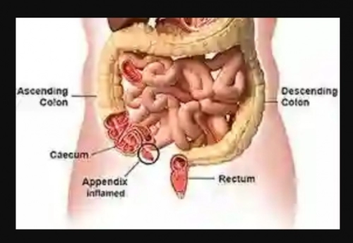 Avoid Excessive Intake Of These 6 Foods If You Have Appendix
