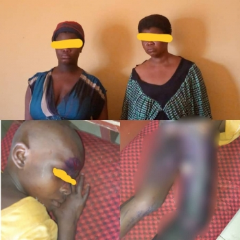 2 Women Arrested For Pouring Hot Water On 10-year-old Maid In Anambra (Graphic Pics)