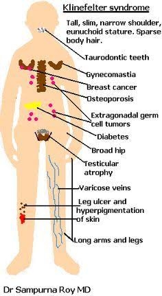 Klinefelter Syndrome Klinefelter Syndrome