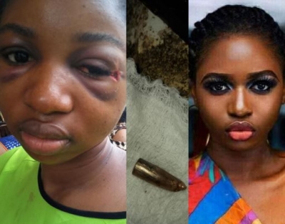Touching Story Of Nigerian Lady Who Survived For 5 Days With Bullet In Her Head (Photos)