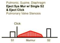 Heart Sounds 23 Pulmonic, Supine, Diaphragm, Ejection systolic murmur with single S2 and Ejection click, Pulmonary valve stenosis .mp3