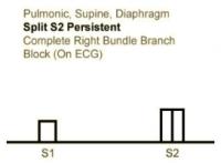 Heart Sounds 19 Pulmonic, Supine, Diaphragm, Spilt S2 Persistent, COmplete Right Bundle Branch block (on ECG).mp3