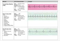 EKG Flash Chart (Characteristics of EKG types .pdf